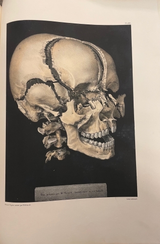 Portada de Trait� Complet de L'Anatomie de L'Homme comprenant L'Anatomie Chirurgicale et La M�decine Op�ratoire. Tomo I y II. Ost�ologie - Syndesmologie. Myologie-Apon�vrologie - Bourgery et Claude Bernard