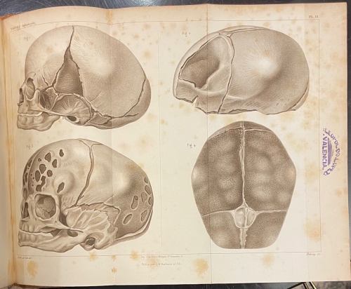 Portada de Etude Medico-Legale sur L'Infanticide - Ambroise Tardieu